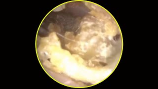 Tympanic membrane perforation and postoperative debridement for cholesteatoma 58 [upl. by Aniroz]