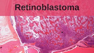 Retinoblastoma  Pathology mini tutorial [upl. by Myra556]