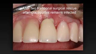 LAPIP Laser Assisted Peri Implantitis Procedure [upl. by Kunkle]