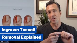 Ingrown Toenail Removal Dr Moore Explains the Permanent Cosmetic Procedure [upl. by Bellda]