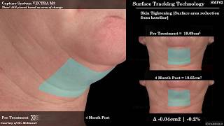 SculpSure for Submental Fat Reduction Under the Chin Fat [upl. by Melony]