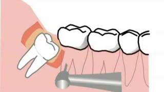 spezielle Komplikationen bei der Weisheitszahnentfernung neue Version [upl. by Ohcamac]