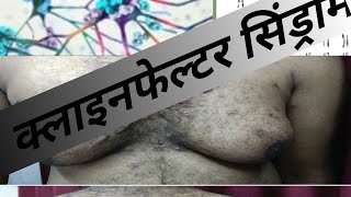 klinefelter syndrome  klinefelter syndrome in hindi class 12 biology  क्लाइनफेल्टर सिंड्रोम [upl. by Hibbitts]