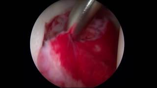 Inflammatory Synovitis  Synovectomy Surgery  Hip Specialist [upl. by Anel]