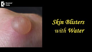 Skin Blisters with Water Causes Treatment Draining Prevention  DrAruna Prasad  Doctors Circle [upl. by Marashio481]