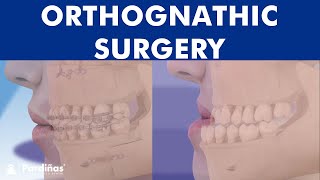 ORTHOGNATHIC surgery  All about JAW realignment surgery © [upl. by Julian41]