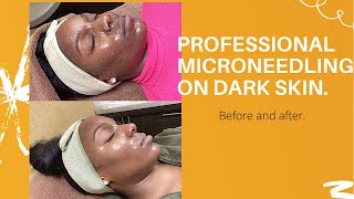 Professional microneedling on dark skin Part 2 [upl. by Hellman671]