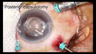 Silicone oil induced epiretinal membrane ERM removal [upl. by Aillemac275]