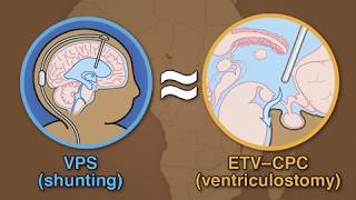 Treatment for Postinfectious Hydrocephalus in Infants [upl. by Ahnavas]