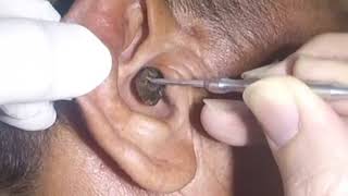 Removing MASSIVE Earwax from Mans Ear [upl. by Aitetel281]