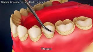 Teeth scaling to remove plaque  3d animated video  Dental Solutions Clinic Bangalore [upl. by Sheff]