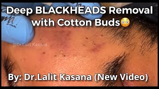 Deep Blackheads Removal with Cotton Buds by DrLalit Kasana [upl. by Nirik]