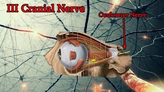 Oculomotor Nerve Palsy III Cranial Nerve palsy Medical animation [upl. by Aivartal378]