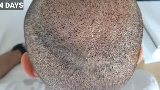 FUE Hair Transplant Timeline  Month 1 to 6  Before amp After [upl. by Haywood]