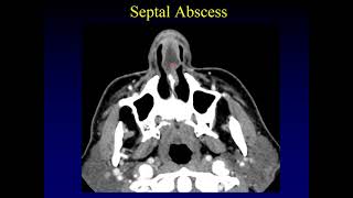 Imaging of the Paranasal Sinuses 3 [upl. by Enileuqcaj]