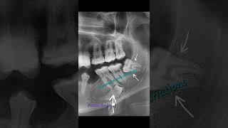 Sharp bending severe curvatures and dilacerated roots of permanent third molars surgical exodontia [upl. by Kalvin799]