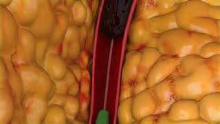 Peripheral Thrombectomy Animation [upl. by Ecirehc]