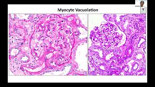 POST RENAL TRANSPLANT DRUG TOXICITY  Dr Vinita Agarwal Lec 9 [upl. by Ahsi431]