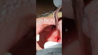 Peritonsillar abscess  Quinsy  Dr Hitesh Patel [upl. by Esbenshade]