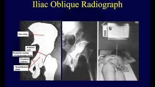 Acetabulum fracture radiographic evaluation OTA lecture series III v04b [upl. by Tcideneb817]