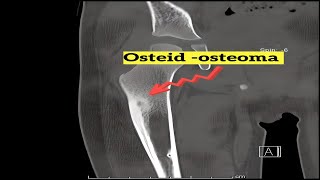 Osteoid Osteoma Insights [upl. by Suiratnod755]