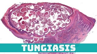 Tungiasis Sand Flea Under the Microscope Tunga penetrans aka jigger flea skin pathology [upl. by Harbert377]