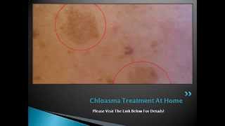 Chloasma Treatment At Home  How to Get Rid of Chloasma or Melasma Naturally [upl. by Birchard]