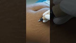 Stretch Marks Inkless Removal Boleyn Treatment Los Angeles 🌍 shorts [upl. by Ronoc]