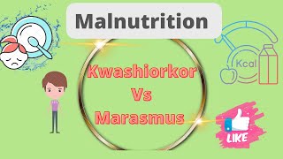 Kwashiorkor vs Marasmus DefinationDifference Malnutrition Nursing notes [upl. by Eecram215]