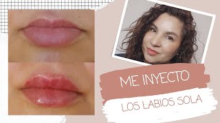 COMO ME INYECTO ÁCIDO HIALURONICO EN MIS LABIOS DE MANERA SEGURA titaeve acidohialuronico labios [upl. by Faubion]