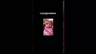 Laryngomalacia [upl. by Nnyleitak]