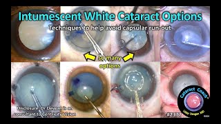 CataractCoach™ 2377 options for intumescent white cataracts [upl. by Sparke]