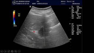 CT Angiography Case15 Portal Vein Thrombosis  Portocaval shunt [upl. by Kashden571]