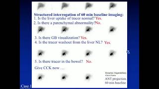 Hepatobiliary Scintigraphy in Chronic Abdominal Pain by Mark Tulchinsky MD FACNM [upl. by Lally]