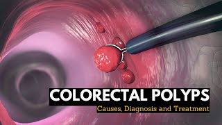 Colorectal Polyps Causes Signs and Symptoms Diagnosis and Treatment [upl. by Rehpotsirhk]