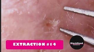 Whitehead and BlackHead RemovalExtraction 14 [upl. by Sito]