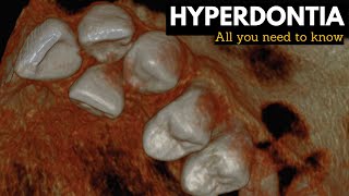 Hyperdontia Causes Signs and Symptoms Diagnosis and Treatment [upl. by Asiole931]