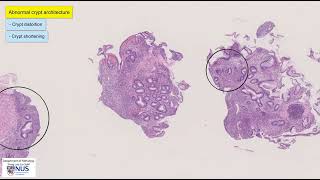 Ulcerative colitis microscopy  Talking slide [upl. by Fortunato]