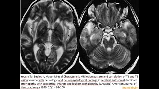 70 CADASIL Notch3 arteriopathy pericyt blood brain barrier anterior temporal pole stroke [upl. by Octave]