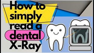 How To Understand Your Dental Xrays  How to Read Dental XRays Radiographic Interpretation [upl. by Ferriter998]