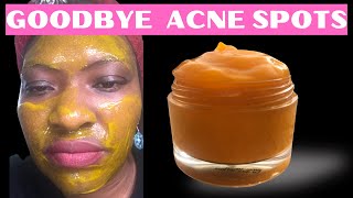 I Tried DIY ACNE FACE MASKS for 30 Days and Got AMAZING Results [upl. by Munford]