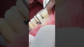 Retraction cord satisfying [upl. by Littman]