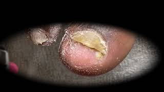 Ingrown Toenails Treatment Satisfying Pedicure Manicure 17 [upl. by Ozkum]