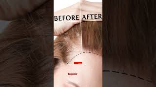 Minoxidil 1052 Mintop  Hair lossHair ReGrowBaldness Doctor Meds Uses In HindiampEngSub [upl. by Avera]