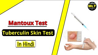 Tuberculin Skin Test  Mantoux test  Procedure amp Principle [upl. by Holmen]