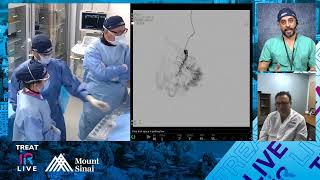 Embolization of a Recurrent Hand Arteriovenous Malformation AVM using NBCA Liquid Embolic [upl. by Garrick388]