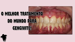 Gengiva Inflamada e Sangrando DESCUBRA Qual o Melhor Tratamento Caseiro DO MUNDO Para Gengivite [upl. by Enier462]