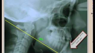 Simplified cephalometric analysis for orthodontic treatment [upl. by Ashti49]