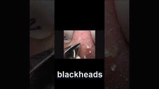 角栓 除去 blackheads removal [upl. by Lynch]