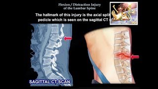 Lumbar Flexion amp Extension Goniometer  Instructional Video [upl. by Murtagh]